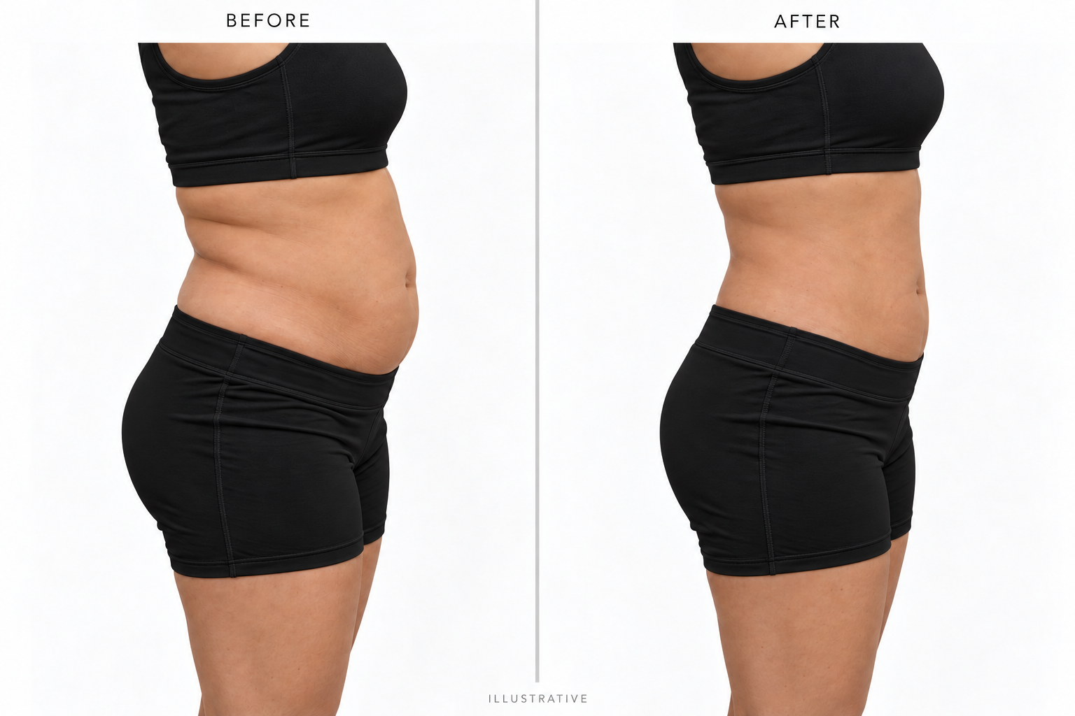Illustrative before and after concept comparing an abdomen in side profile; not an actual client result